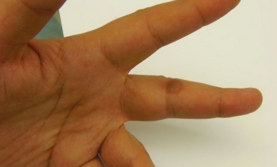 疫情停課在家狂玩3C？小心得皮膚病！