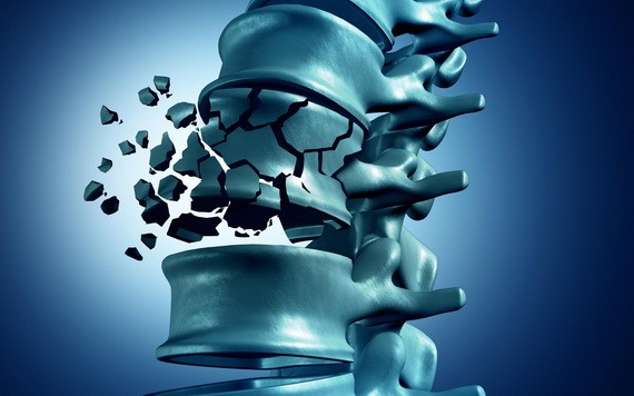 9旬老翁壓迫性骨折，補骨水泥仍痛不欲生！