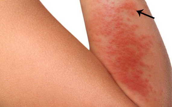 神經性皮炎有４大特點