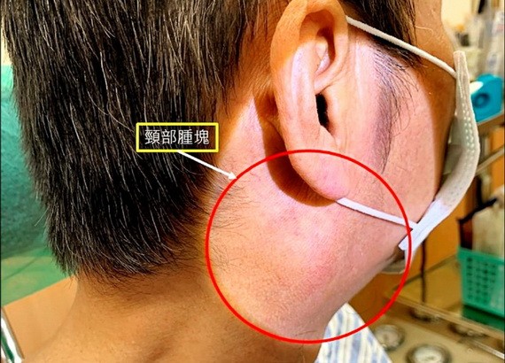 因疫情拖半年才就醫  耳後腫塊竟是這個癌轉移