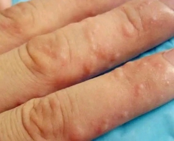 一到夏天就長的“小水泡”