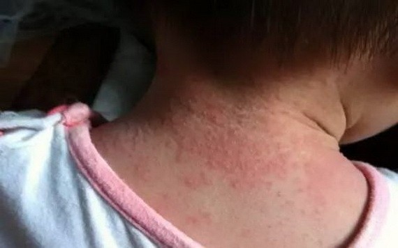 寶寶長痱子，父母要做好這５件事！