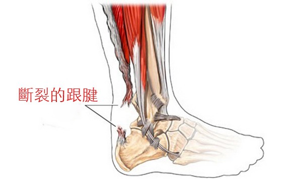 跟腱斷裂到底有多恐怖？