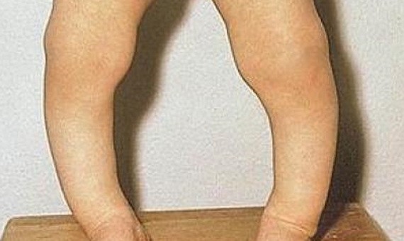 佝僂病４大誘因不可不防！