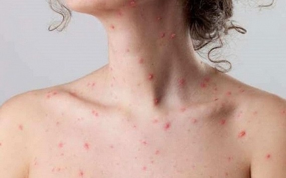 水痘並非兒童“專利”