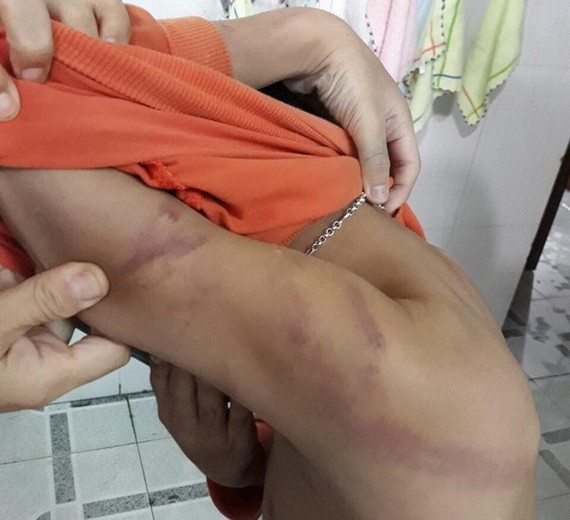 遭親父虐待的小N身上到處都有舊傷新痕。（圖：莉蘭）