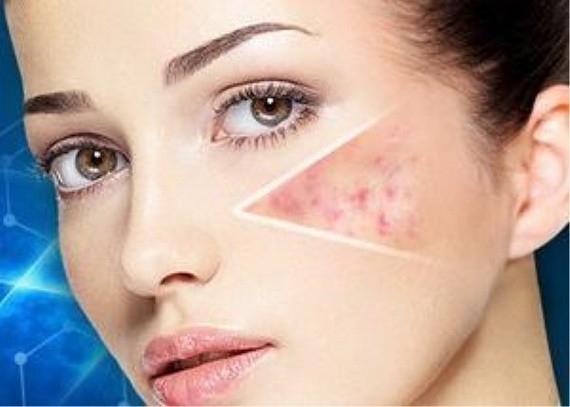 不同類型玫瑰痤瘡症狀不一樣！