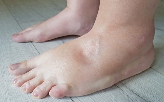 別誤會水腫時不能喝太多水