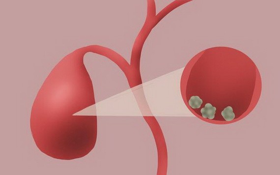 膽結石能不能“保膽取石”？