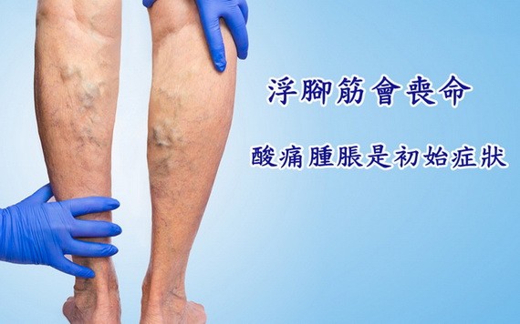 小腿浮青筋像“蚯蚓”靜脈曲張會要命！