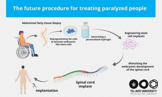 3D 脊髓組織或讓癱瘓者重新行走