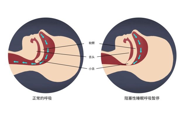 如何治療阻塞性睡眠呼吸暫停綜合症