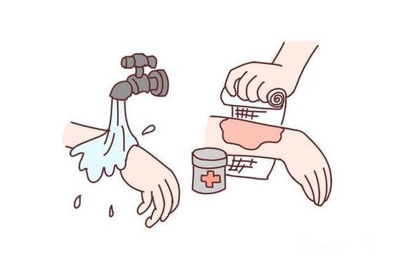 被燙傷後該如何處理？