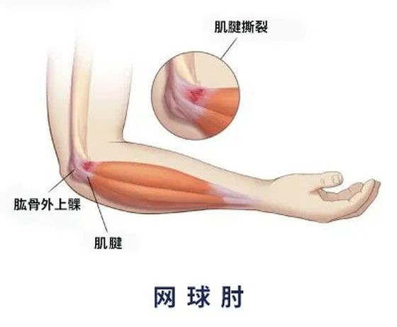 手肘痛就是網球肘？