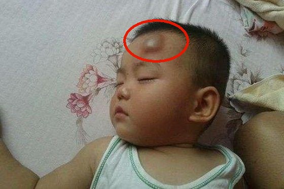 跌倒頭上磕出大包？專家：４件事不能做