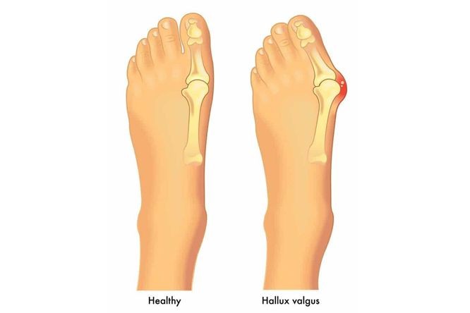 脚踇趾外翻很难看需要看病治疗？