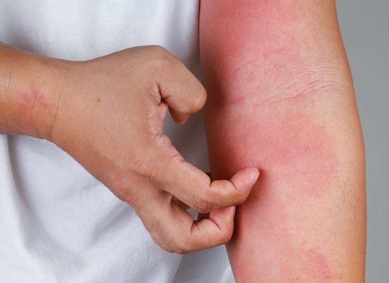 身体红痒脱屑、抠破皮出水！