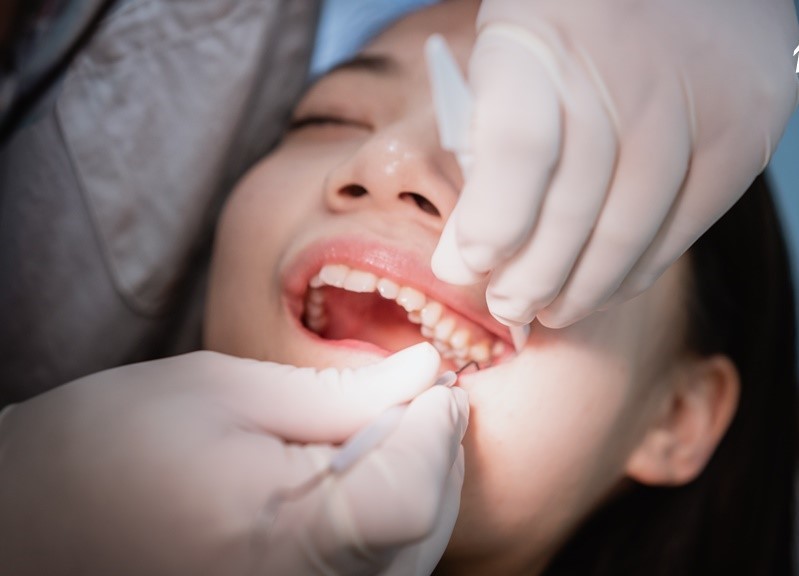 拔智齿后该如何照护？