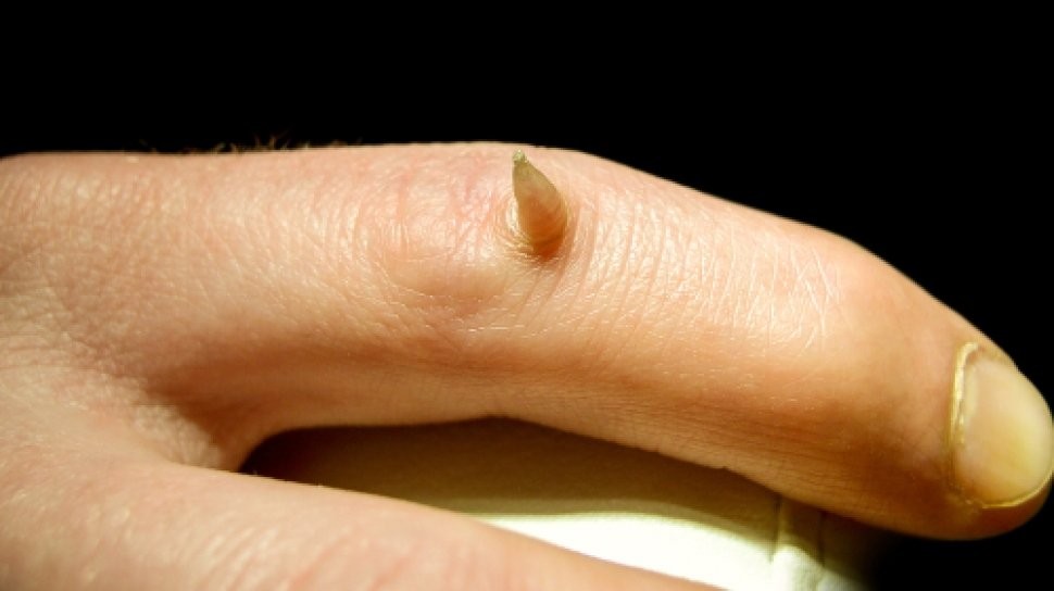 人的皮肤竟然也会长「角」