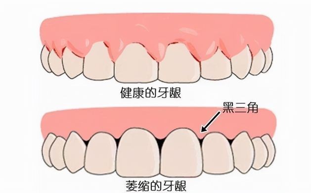 别再因牙龈萎缩烦恼