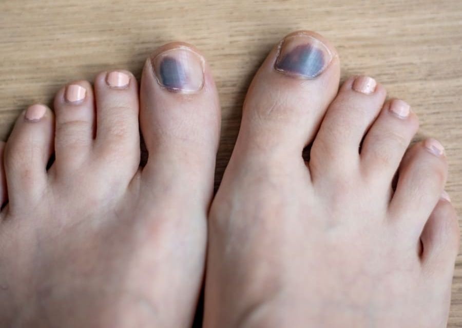 医生提醒甲下出血别轻忽