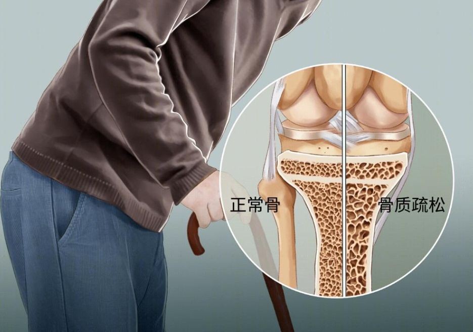 别忘预防骨质疏松