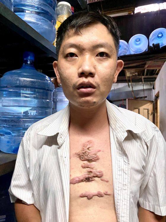 文长发胸前的蟹足肿。