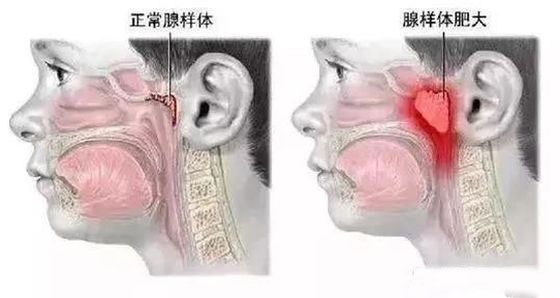 警惕孩子患上腺样体面容