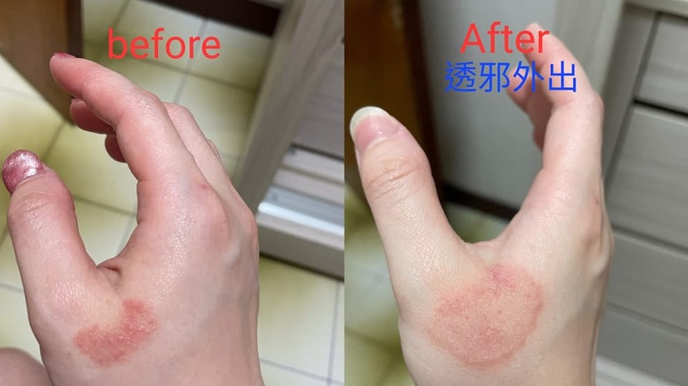 皮疹愈来愈大片、变薄表示病症开始好转。