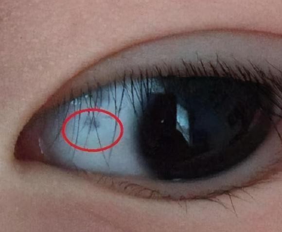 眼睛上出现白点或是患有睑缘炎？