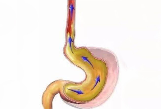 灼烧年轻人的胃病