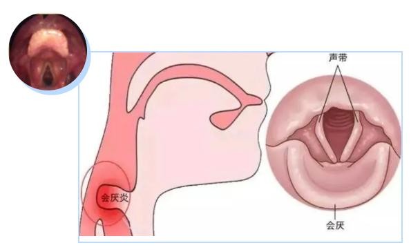 喉痛、呼吸困难时当心“夺命凶手”会是厌炎
