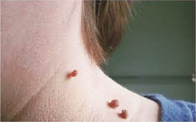 脖子上长“小肉粒”能直接用手揪掉？