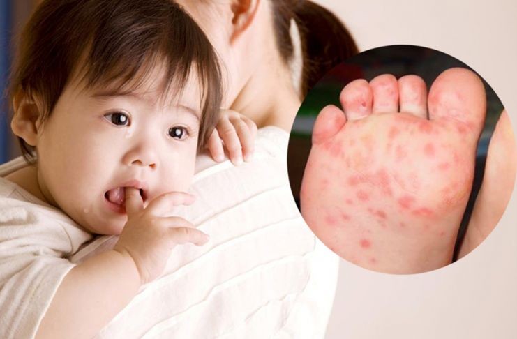 手足口病进入高发期，疫苗及卫生很重要