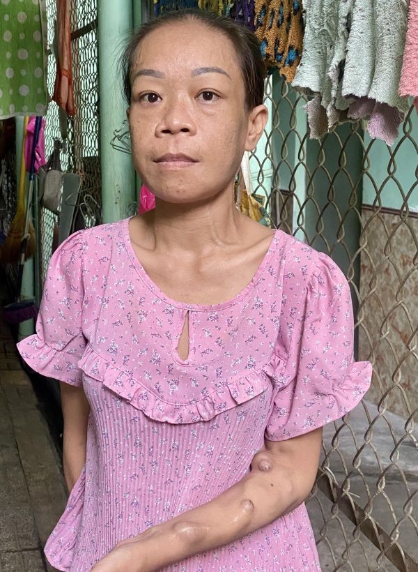 陈清香与她洗肾的手。