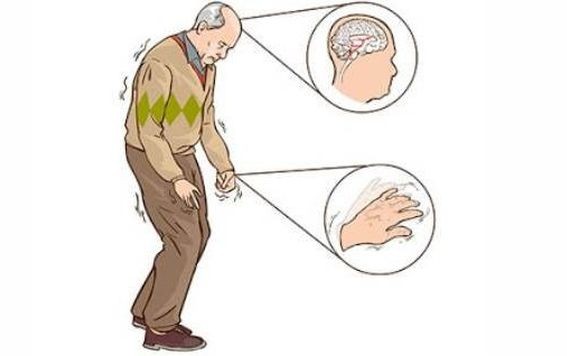 帕金森症状如何早发现？