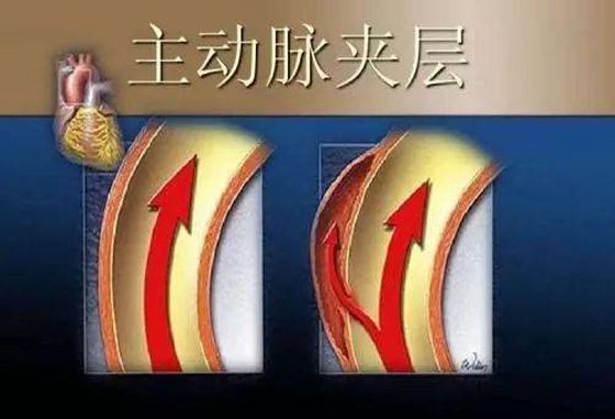 该怎防比心梗还凶险的主动脉夹层？