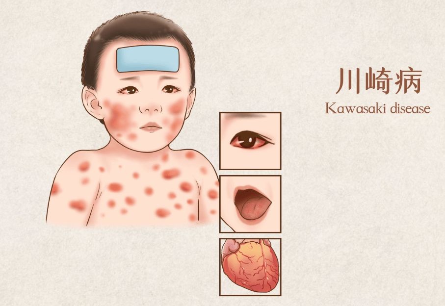 孩子反覆发热、眼睛红、起疹子？可能是川崎病的信号