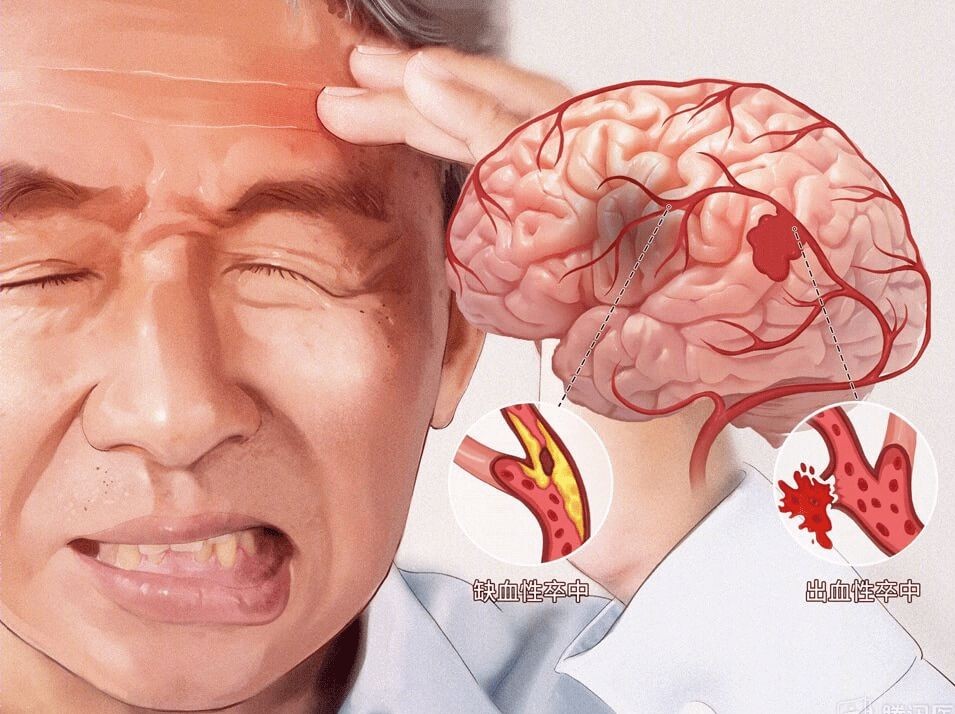 学会快速识别脑卒中，抓住黄金抢救时间