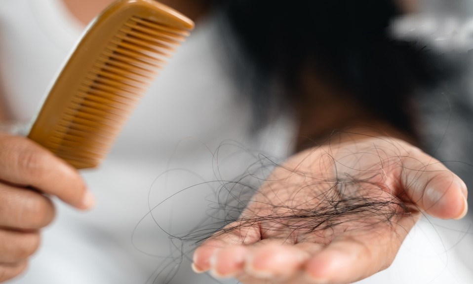 女生也会雄性秃？ “这形状”秃发要注意！