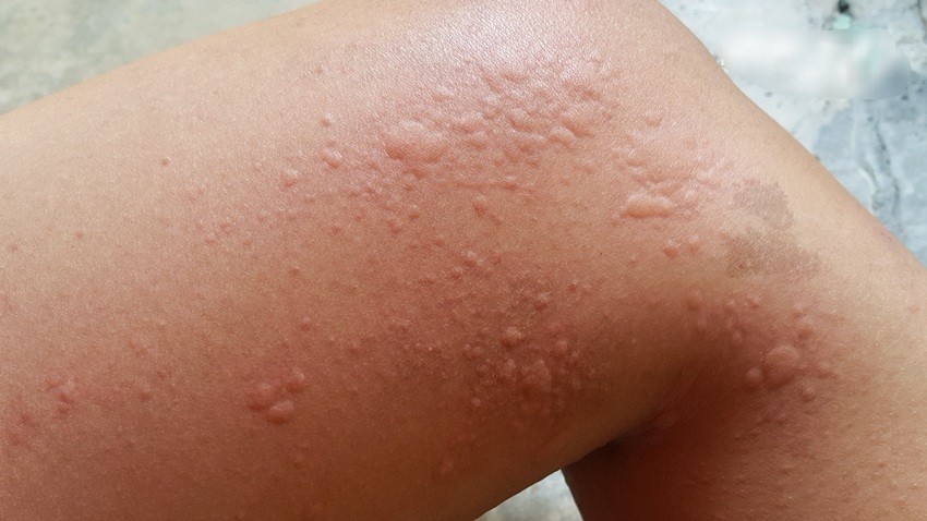 荨麻疹反覆发作 “想好的快”这事千万不能做