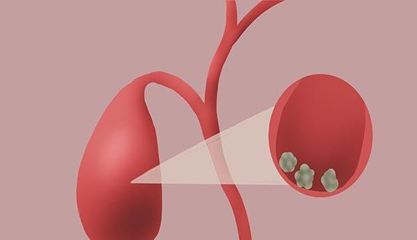 生活中的这些习惯，可能增加胆结石发生风险！