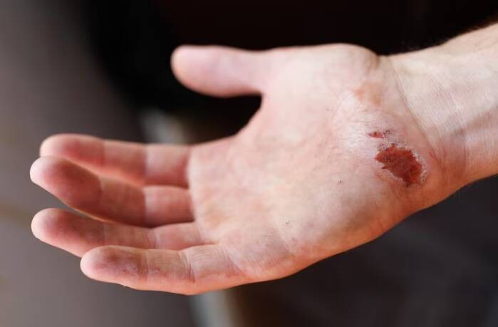 医师表示，若皮肤有伤口而感染噬肉菌，会导致坏死性肌肉发炎；若进入到血液，死亡风险恐增加。（示意图：Freepik）