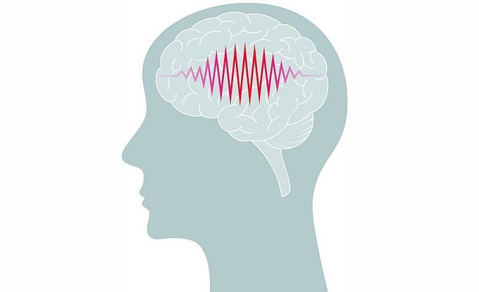 人为什么会得「癫痫」？