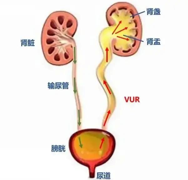 宝宝也会尿路感染？
