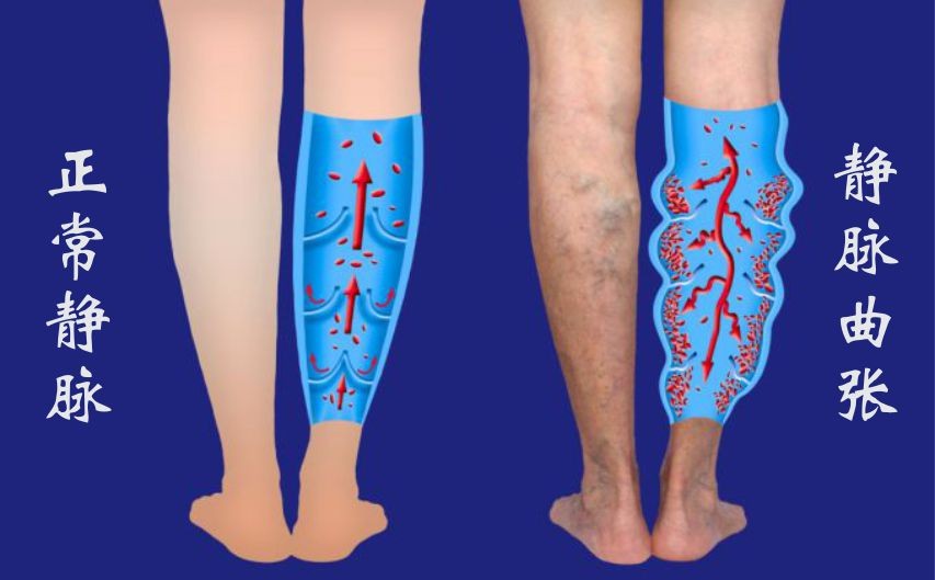 久坐、不常运动、水喝不够等是容易导致静脉曲张的原因。