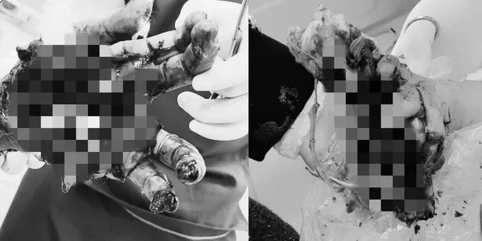 患者双手因爆竹爆炸受伤。（图：院方提供）