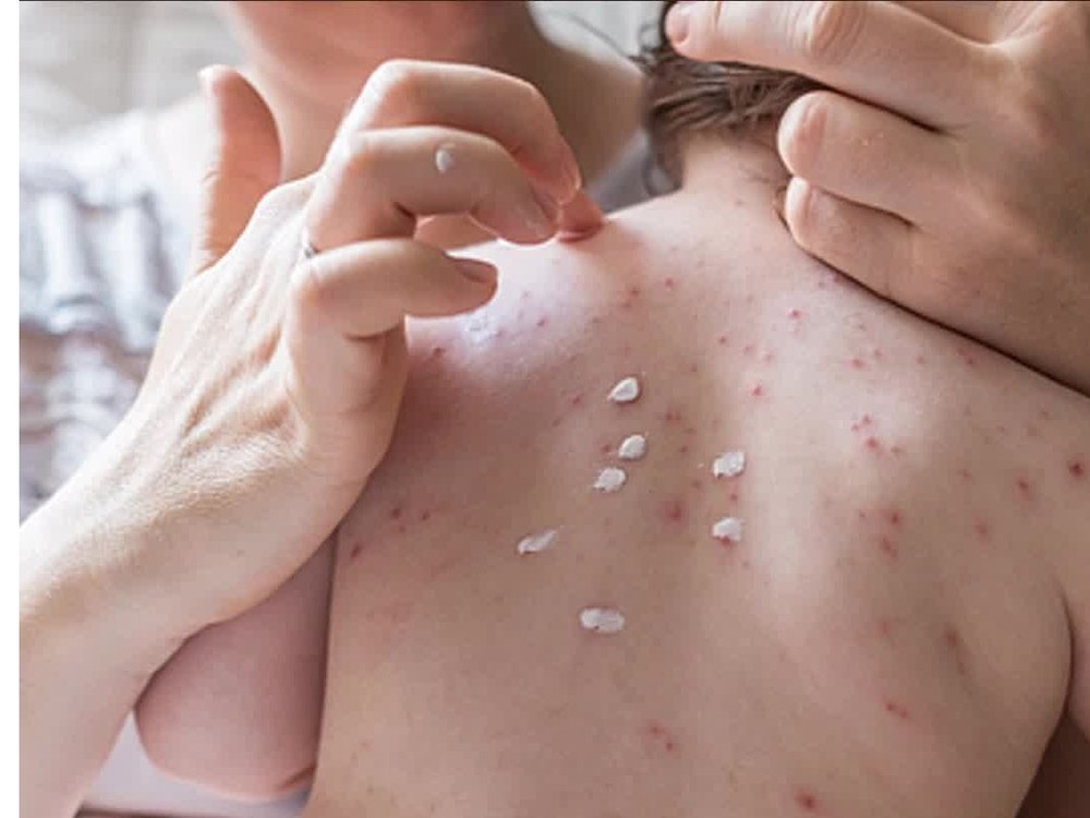 美国麻疹疫情造成两人死亡。（示意图：互联网）