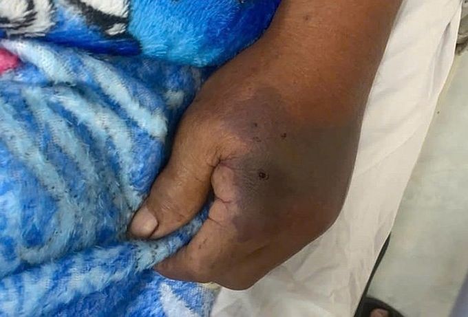 手背上的蛇毒牙咬痕。（图：日湖）