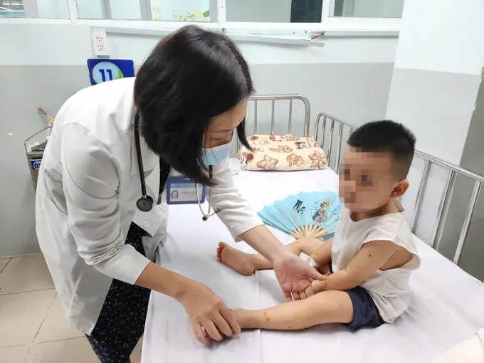 胡志明市第一儿童医院医生为手足口病患儿诊治。